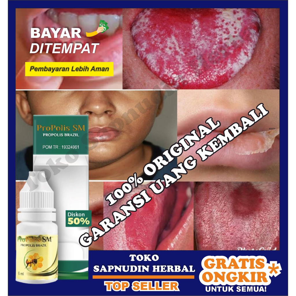 Obat Herbal Untuk Bercak Putih Di Lidah Lidah Sariawan Benjolan Di Lidah Lidah Peta Alami Shopee Indonesia