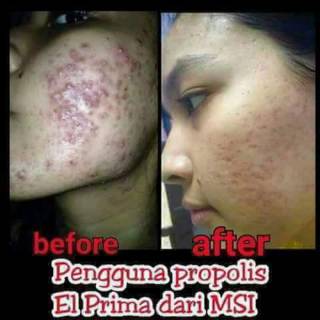 Propolis El Prima Archives Pusat Propolis