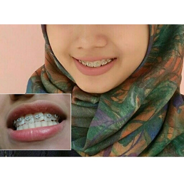 Behel Atas+Bawah Gratis Box+Karet