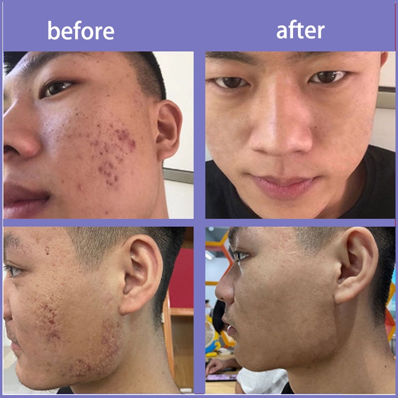 Penghilang bekas luka Acne Cream Scar Removal Penghilang Noda Bekas Jerawat 30g+30g Luka &amp; Stretch Mark scar cream