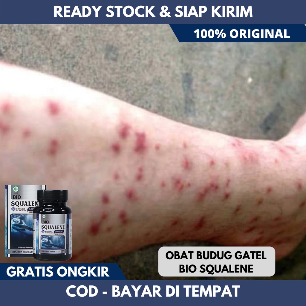 Obat Budug Kaki, Obat Budug Santri, Obat Budugan, Obat Budug, Obat Budug Anak Dan Dewasa, Obat Borok