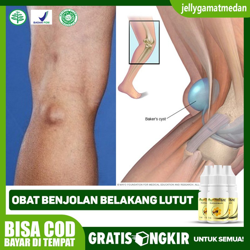 Obat Benjolan Lutut Belakang Lutut Kelenjar Lutut Propolis Sm Terlaris Di Medan Shopee Indonesia