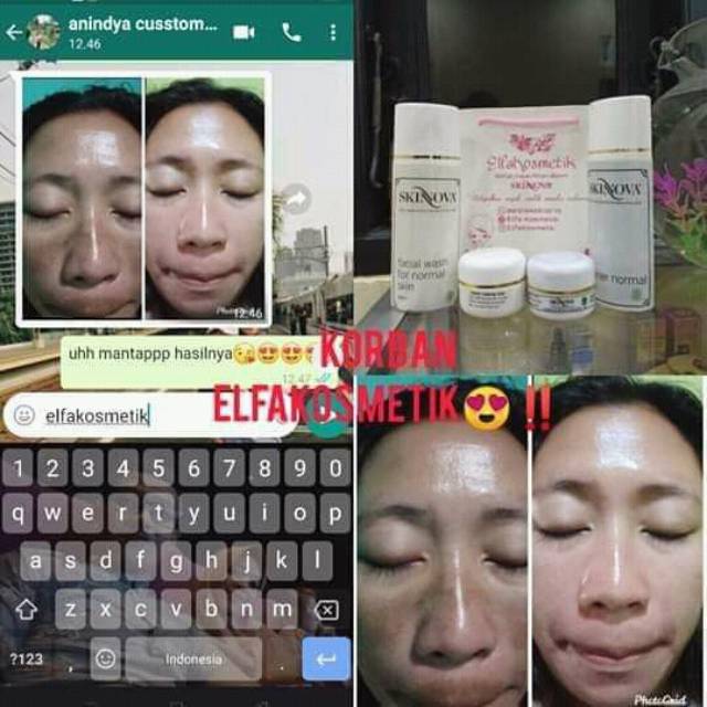 GLOW FORTE OBAT FLRK PARAH FLEK MENAHUN /FLEK WAJAH. .BY ELFAKOSMETIK
