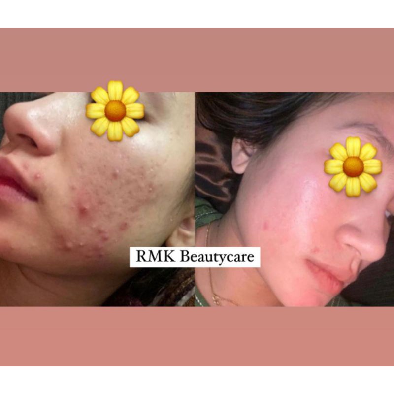 paket acne whitening cream jerawat radang jerawat bruntusan RMK