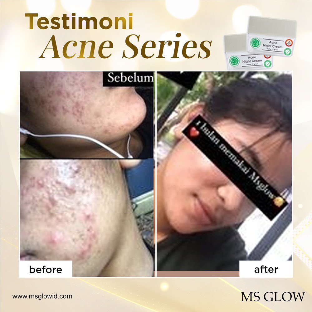 MS Glow - Acne Series - Untuk kulit berminyak, penghilang jerawat & komedo