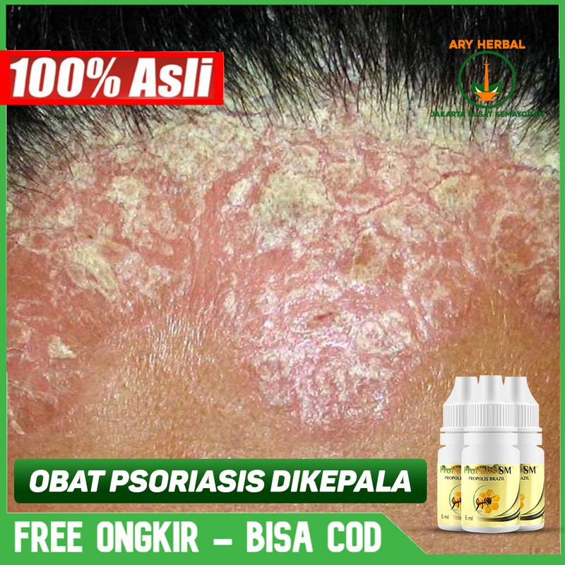 

Obat Psoriasis Di Kepala, Kulit Kepala, Gatal Menahun - Herbal PROPOLIS SM Brazil ASLI Jakarta Pusat