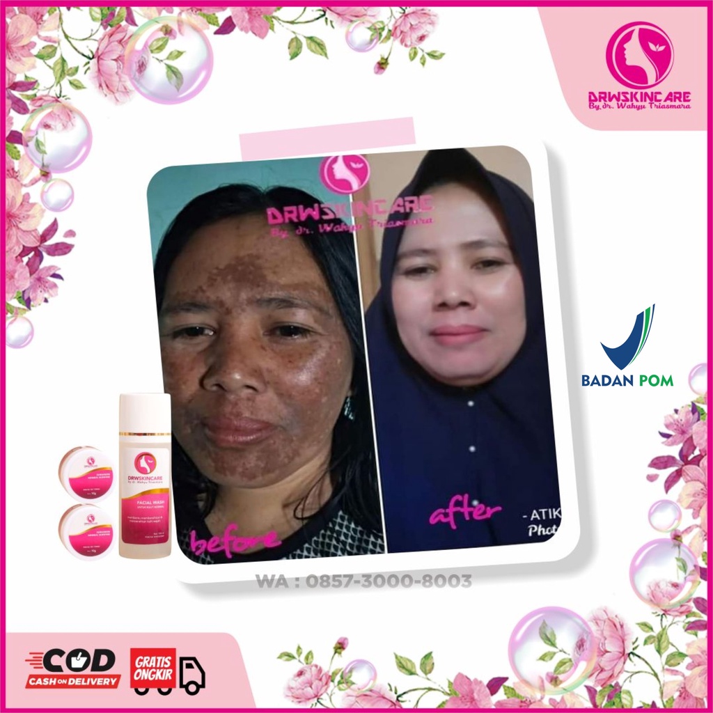 Krim Flek Hitam Melasma Aman BPOM DRW SKINCARE