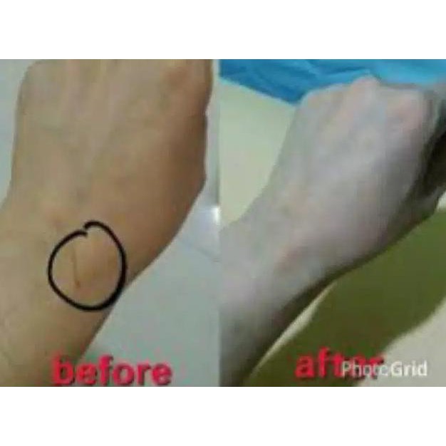 Sale Peeling Badan 20% (10Ml) Pemutih Tubuh Tca Pengelupasan Sel Kulit Mati Terbatas