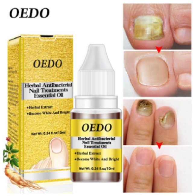 Anti Bau Anti Bakteri dan Jamur Minyak Herbal Oedo Kuku untuk Perawatan Kuku Tangan dan Kaki B