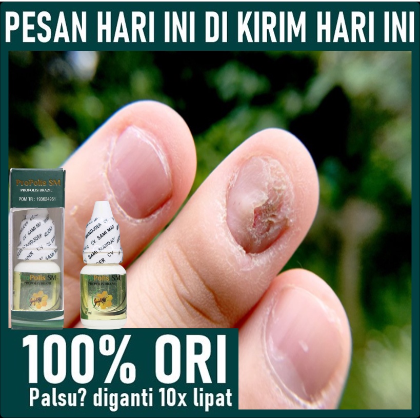 Obat Infeksi Jamur Kuku, Obat Kuku Jamur dan Rusak, Obat Kuku Jamuran Rapuh, Obat Kuku Rusak Kering