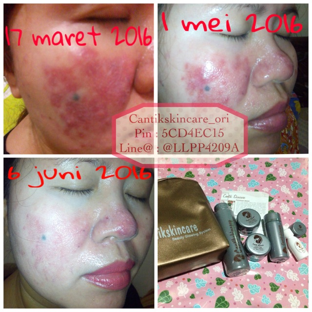Paket wajah Acne Ms Glow by Cantikskincare ready stock