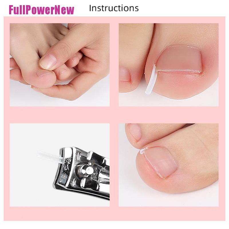 [Full] 10pcs Toenail Straightening Clip Ingrown Toenail Correction Nail Patch Sticker