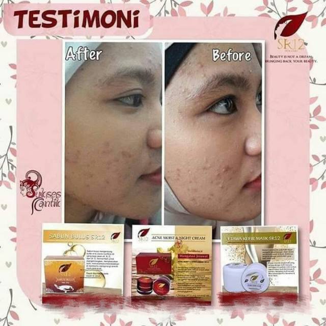 Acne Moist SR12 Cream Penghilang Jerawat BPOM Menjaga Kelembaban dan Melindungi Kulit dari Sinar UV