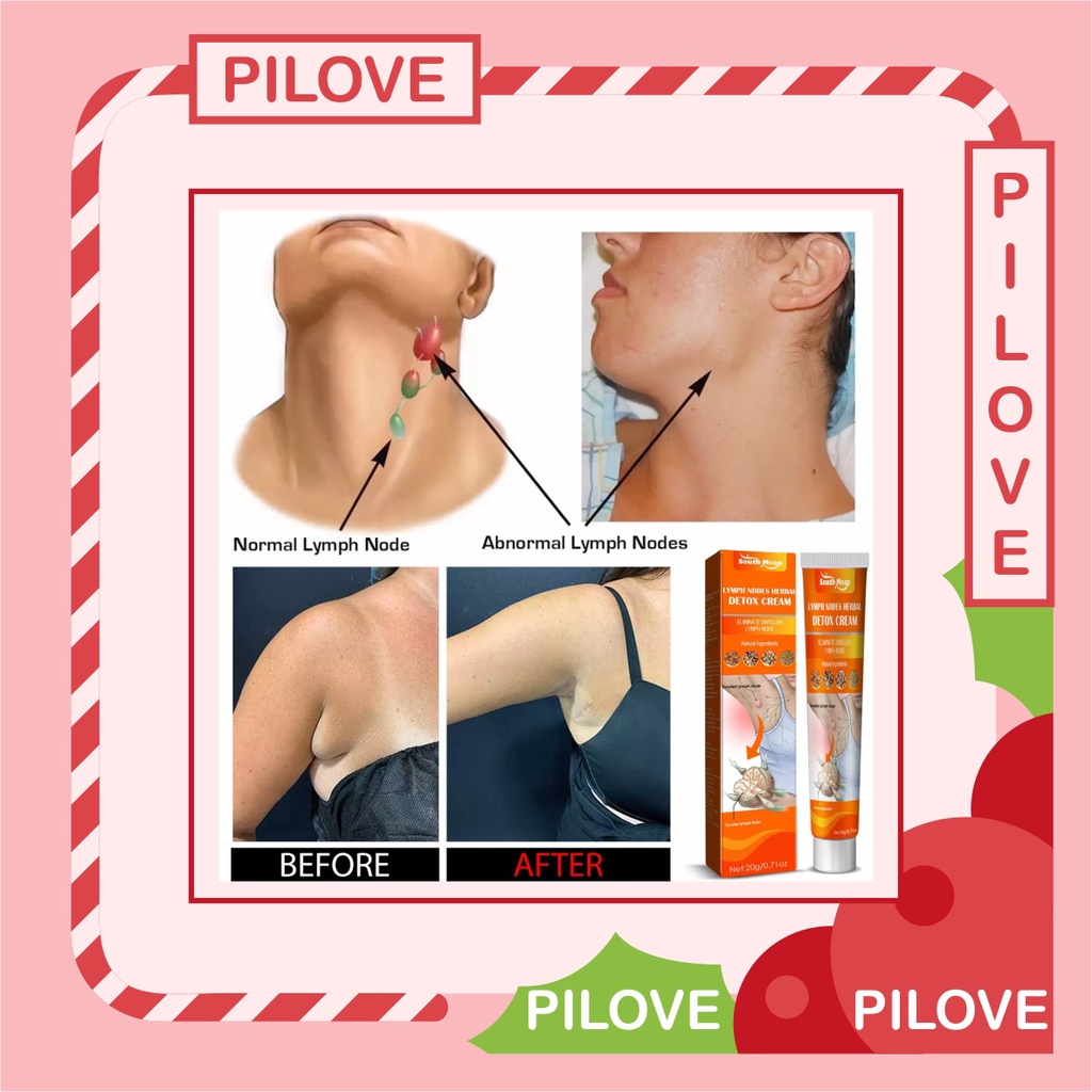 PILOVE - Obat Salep Cream Krim Untuk Penghilang Benjolan Kelenjar Getah Bening Lipoma Limfatik di Area Tubuh dan Badan Uci Uci di Leher Payudara Vagina Tangan Ketiak tanpa Operasi Ampuh