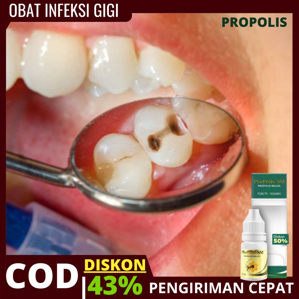PROPOLIS SM | OBAT Abses Gusi kronis, Obat Sakit gigi Parah, Pipi bengkak, obat abses gigi