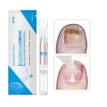 Diskon Salep Jamur Kuku Ampuh | Obat Perawatan Jamur Kuku Jari Tangan Kaki Diskon