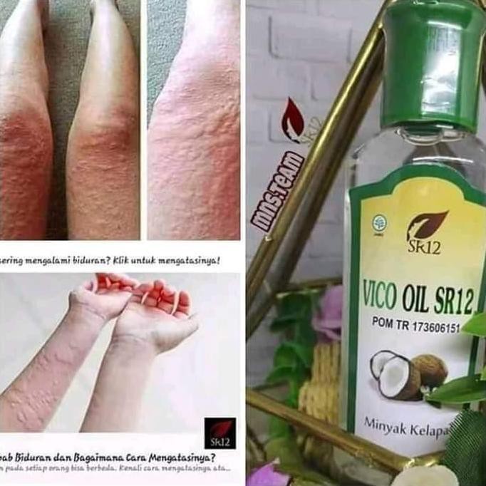 AMPUH!! OBAT PENYAKIT BIDURAN / OBAT PENYAKIT ALIGATA / DARAH DINGIN