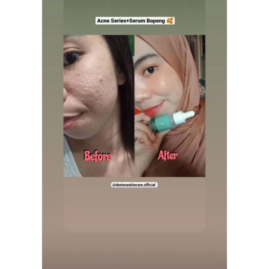 HA SERUM DAVIENA|SERUM BOPENG| DNA SALMON | DAVINA|DAVIENA SKINCARE|DAVIENA|SERUM HA DAVIENA