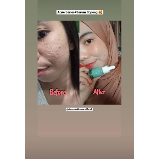 HA SERUM DAVIENA|SERUM BOPENG|DAVINA|DAVIENA SKINCARE|DAVIENA|SERUM HA DAVIENA