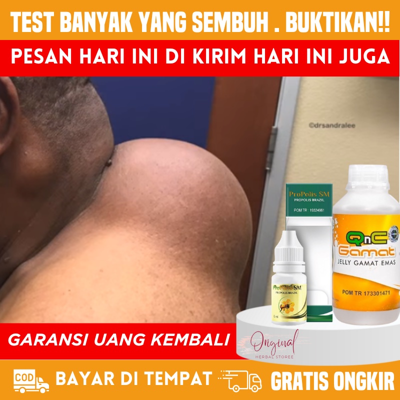 Obat Benjolan di Pundak, Obat Benjolan di punggung, Obat penghancur benjolan, Obat Lipoma, Penghancu