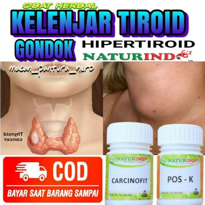 Obat herbal kelenjar tiroid gondok hipertiroid benjolan leher