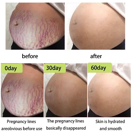 Penghilang strechmark Krim stretch mark Strecth Mark Cream 30ml Krim Perawatan Pascapersalinan Krim Hilangkan Garis-Garis Lemak Menghilangkan Strech Mark Menghilangkan Garis-Garis Lemak Pada Perut, Paha Dan Pantat-4