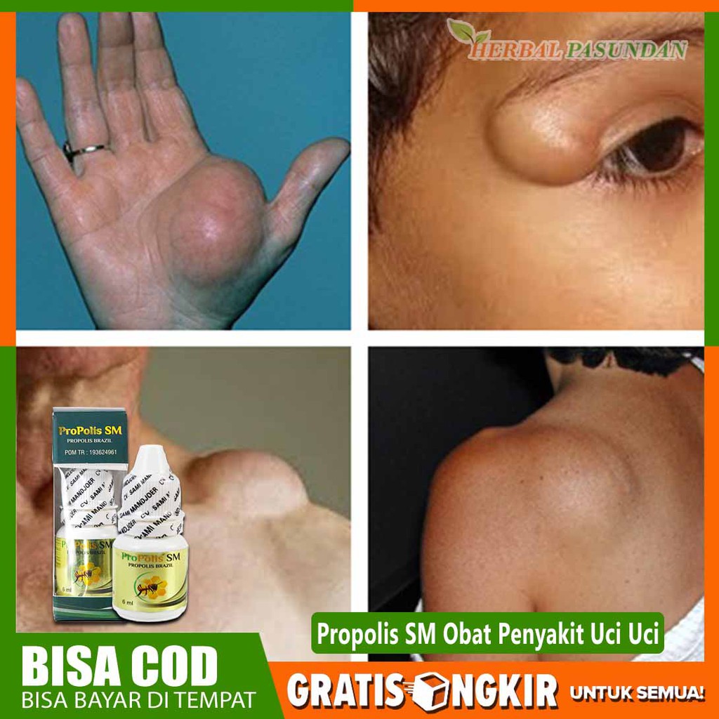 Obat Uci Uci Benjolan Di Tangan Ganglion Benjolan Di Leher Lipoma Herbal Propolis Sm Asli Shopee Indonesia