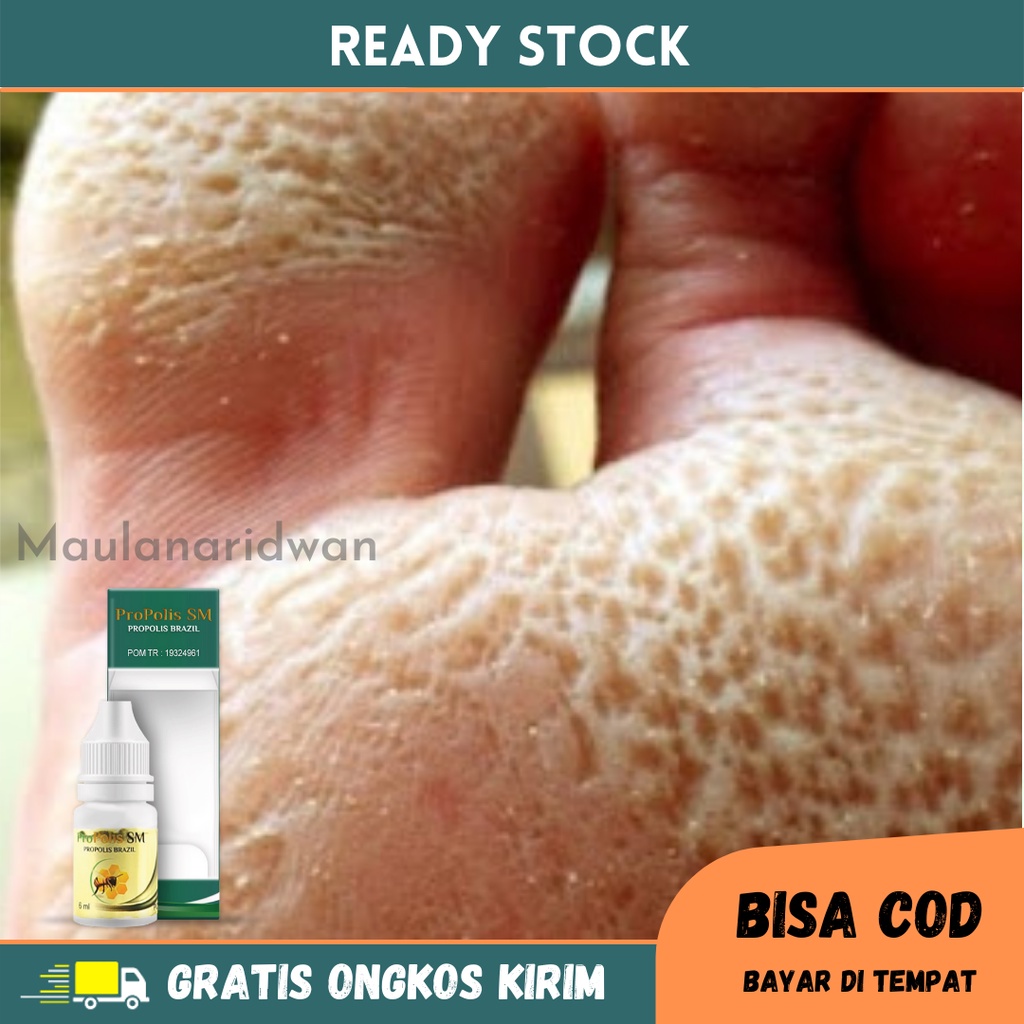 Obat Telapak Kaki Rayapan - Obat Pitted Keratolysis, Obat Telapak Kaki Berlubang, Obat Kaki Rayapan,