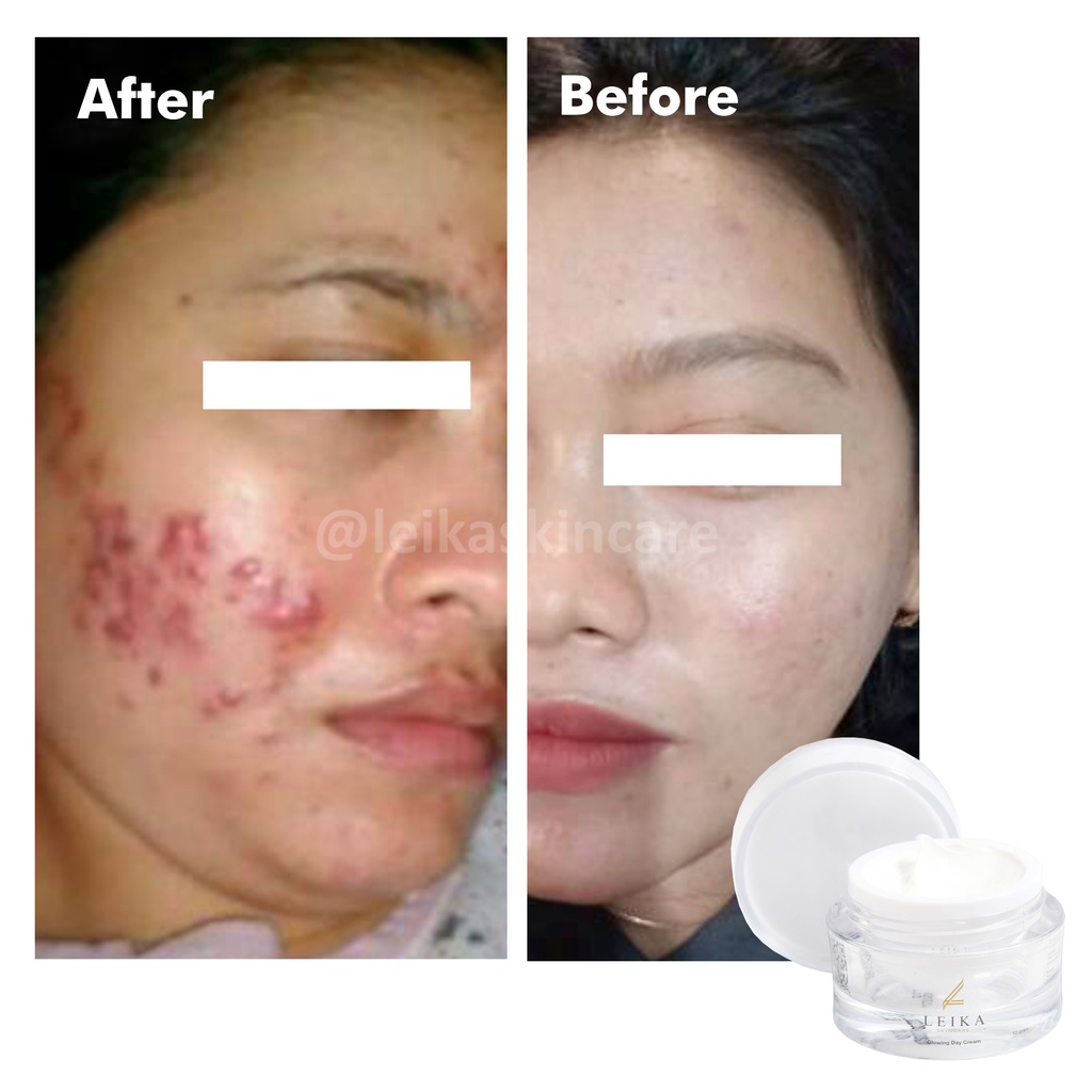 Asli! Penghilang Jerawat / Bekas Jerawat Pria / Wanita Paling Ampuh Permanen Penghilang Jerawat / Pasir / Batu / Bruntusan Leika Skincare Glowing Day Cream 100% Resmi BPOM Halal