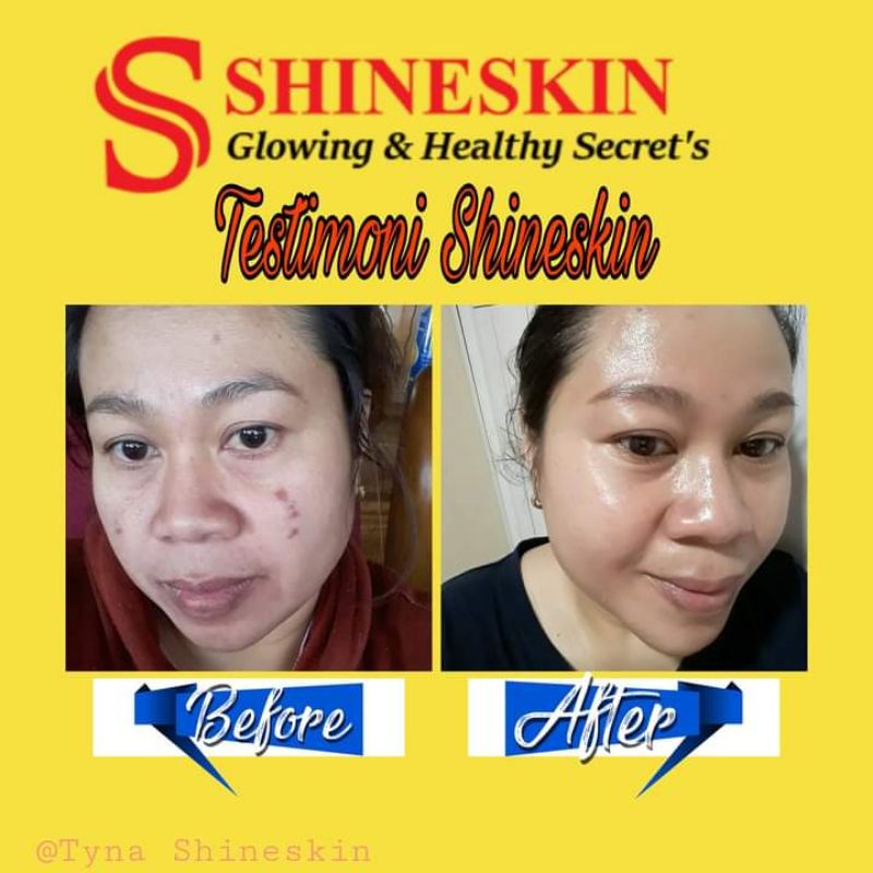 PAKETAN CREAM SHINESKIN SKINCARE UNTUK KELUHAN KULIT BERMINYAK+FLEK HITAM+BEKAS JERAWAT