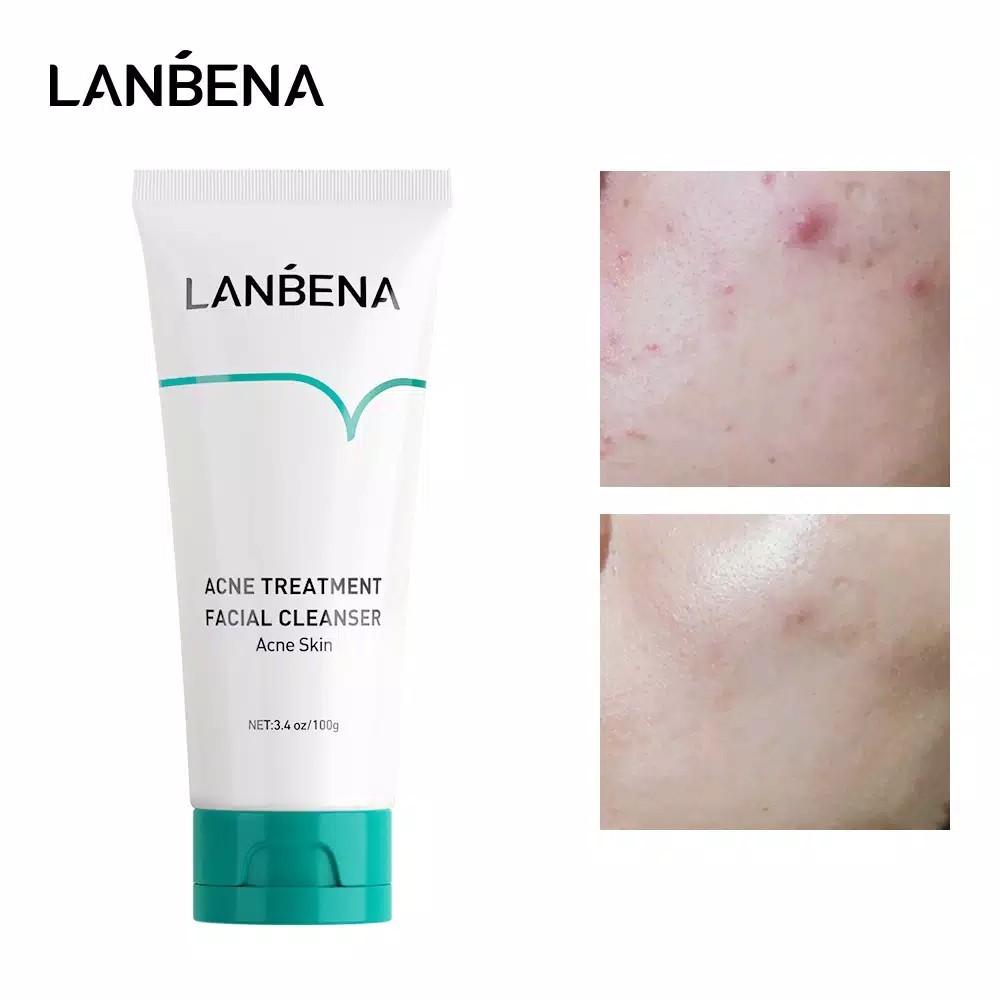 LANBENA Acne Cleanser Treatment Anti Acne Oil Free Pembersih Wajah ORI