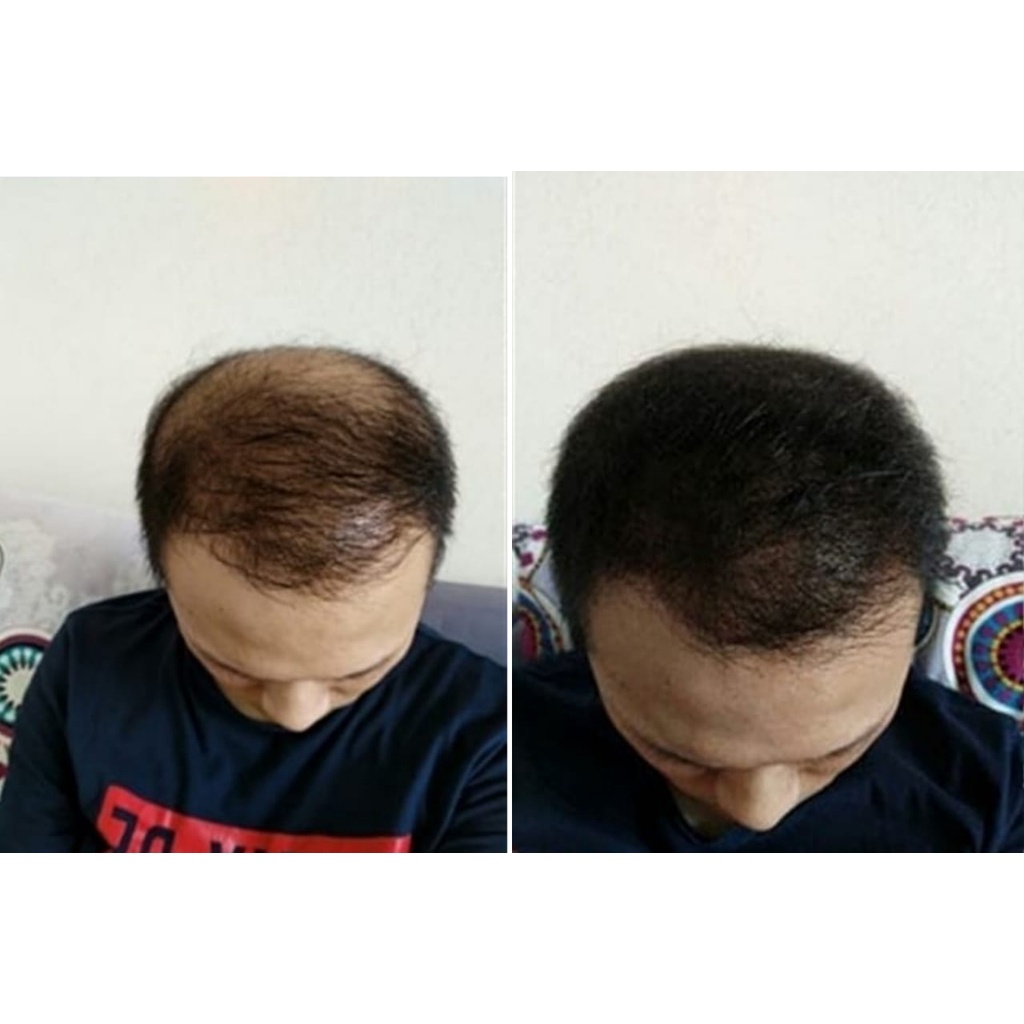 Folihair Shampoo dan Tonic Obat Penumbuh Rambut Botak Serum Rambut Shampo Penumbuh Rambut