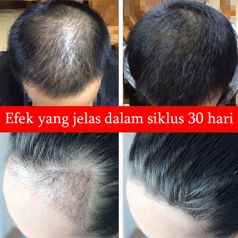 Shampo penumbuh rambut Anti ketombe Sampo anti rambut rontok 400ml Mempercepat pertumbuhan rambut Kontrol minyak yang menyegarkan Anti gatal dan anti ketombe Pelembab ringan Perawatan rambut bergizi