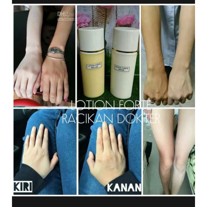 Hb dosting dosis tinggi 5x lebih cepat memutihkan kulit
