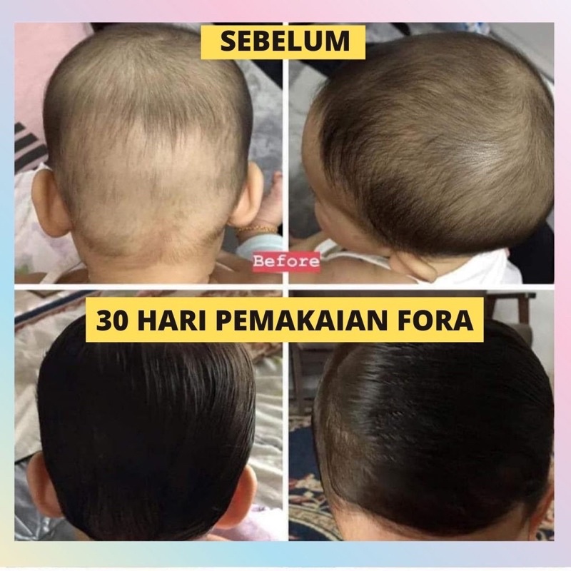 Minyak Kemiri Anak Bayi - 65ML by Fora - Penebal Alis - Penebal Rambut - Candlenut Oil