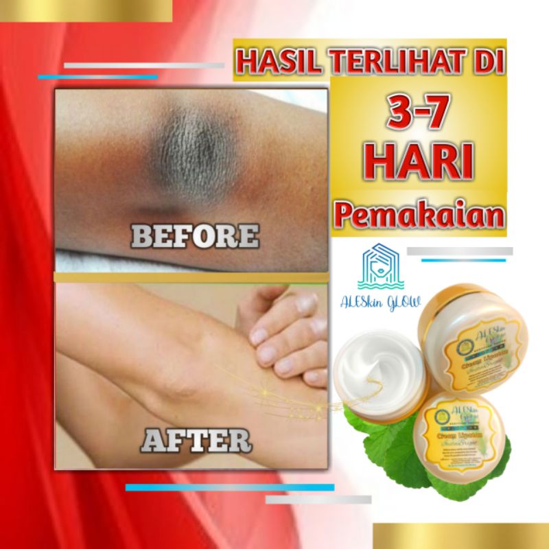 MALAYEKA CREAM PEMUTIH KETIAK Bokong Leher dan Selangkangan-Cream Pencerah Lipatan-Cream Underarm