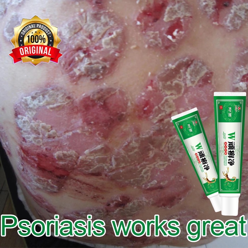 COD Eczema Cream Chinese Herbal Krim kudis kurap panau ruam Psoriasis Antifungal Antibacterial Itchy