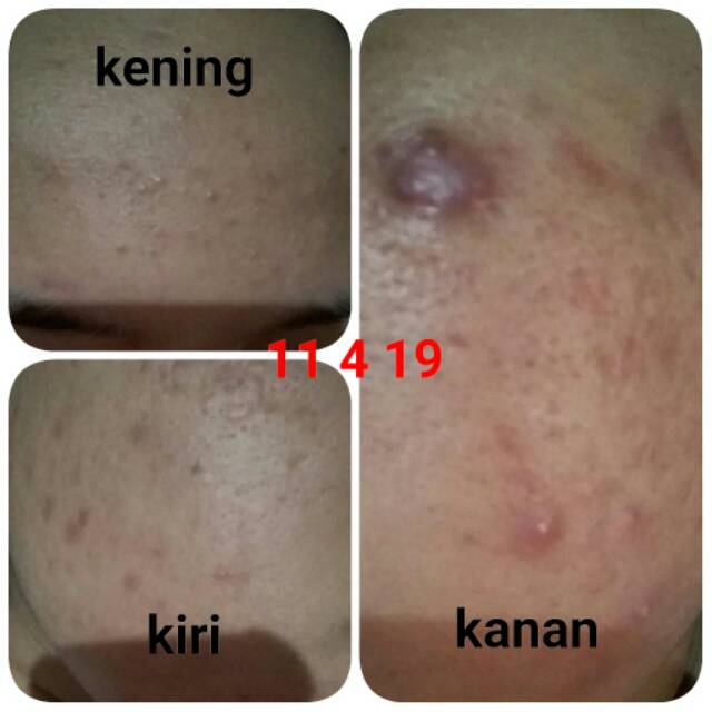 Serum acne