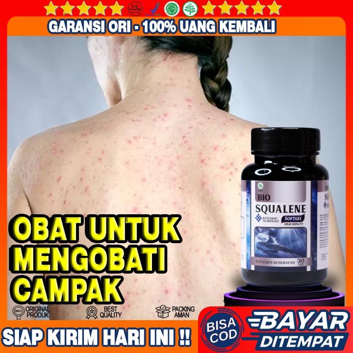 Obat Penyakit Campak - Obat Sakit Campak - Obat Campak Anak Dan Dewasa - Obat Campak Rubella - Obat 