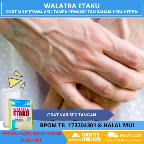 Obat Varises Tangan, Varises Di Lengan, Urat Tangan Menonjol, Urat Bengkak, Penghilang Varises Di Ta