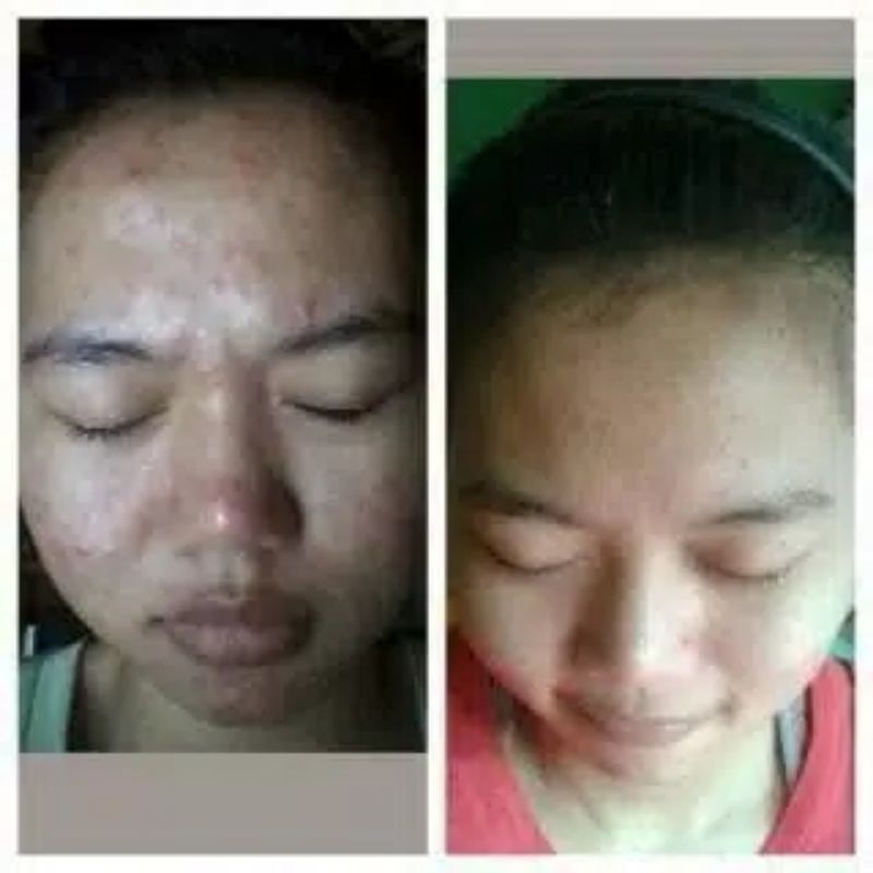MASKER CHITIN CHITOSAN SOLUSI KULIT BOPENG, BERJERAWAT DAN PENGHILANG FLEK HITAM-3