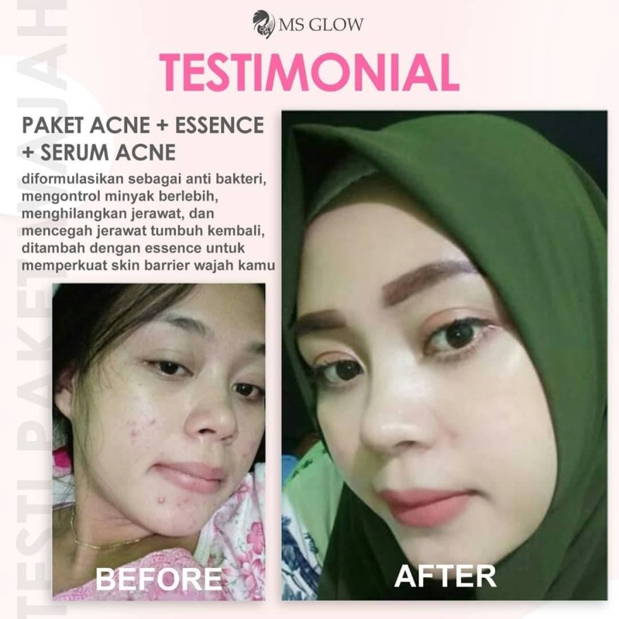 Ms Glow Paket Acne Series Free Pouch / Cream Penghilang Jerawat