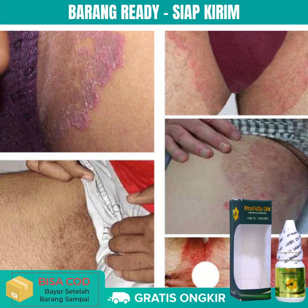 Obat Kulit Gatal Selangkangan Pria Wanita, Obat Gatal Jamur Kulit, Obat Gatal Eksim Scabies, Obat Ga