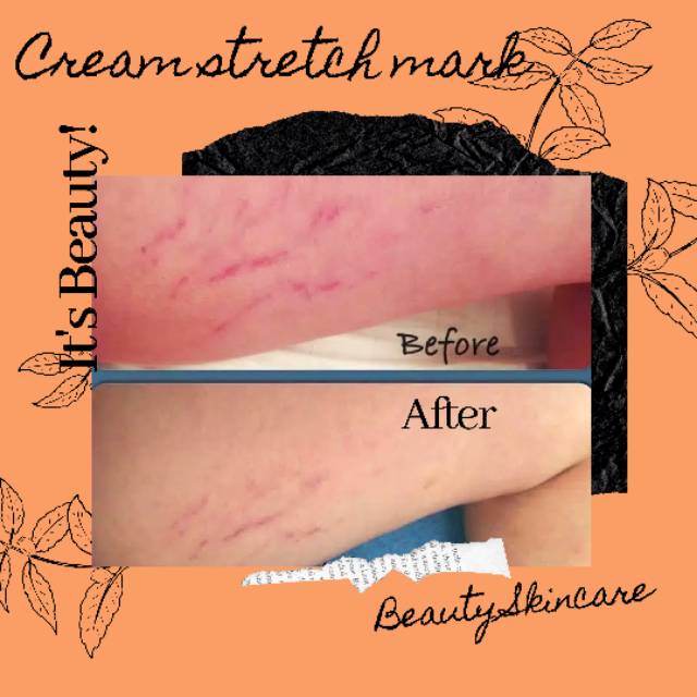 ( FYBEAUTY ) Cream Penghilang Stretch Mark / Selulit Isi -+10gr