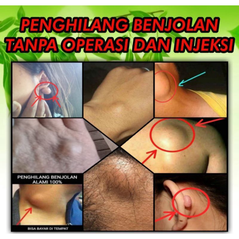 OBAT PENGHILANG BENJOLAN, BEKAS LUKA, KELOID, AMBIEN, ISI 5 AMPUH CHITIN CHITOSAN ORIGINAL TIENS