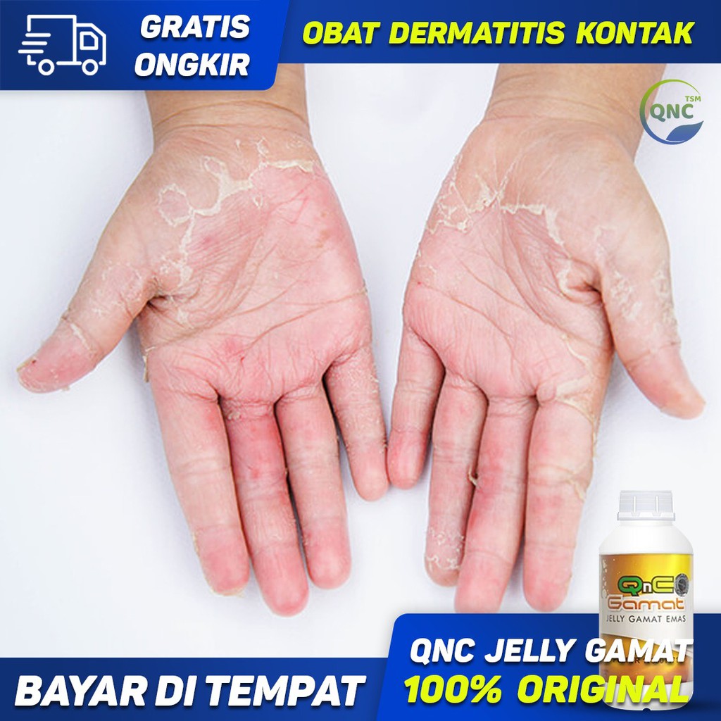 Obat Dermatitis Kontak, Obat Dermatitis, Obat Ruam Kulit - QnC Jelly Gamat