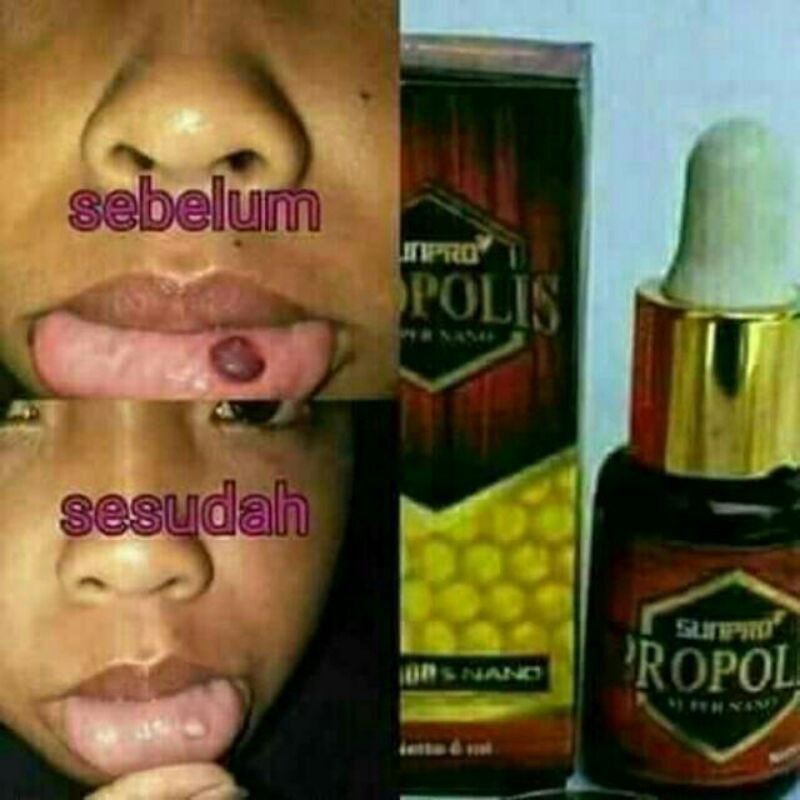 PROPOLIS SUNPRO Obat Sejuta Manfaat Asli Nasa