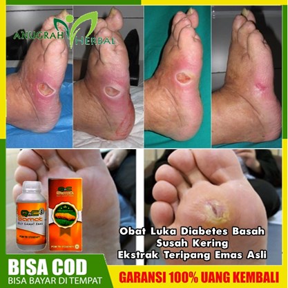 Obat Diabetes Basah Luka Susah Kering Ekstrak Teripang Emas Asli | Herbal Penghilang Bau Busuk, Tanp