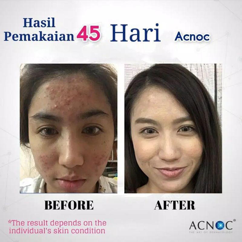 Acnoc Anti Acne Gel