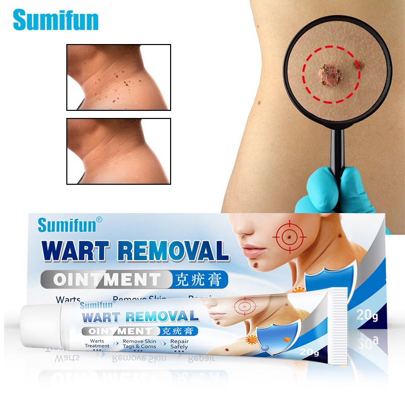 Sumifun Wart Remover Cream Skin Tag Remover Ointment 60gr - Menghilangkan Kutil Tahi Lalat Mata Ikan